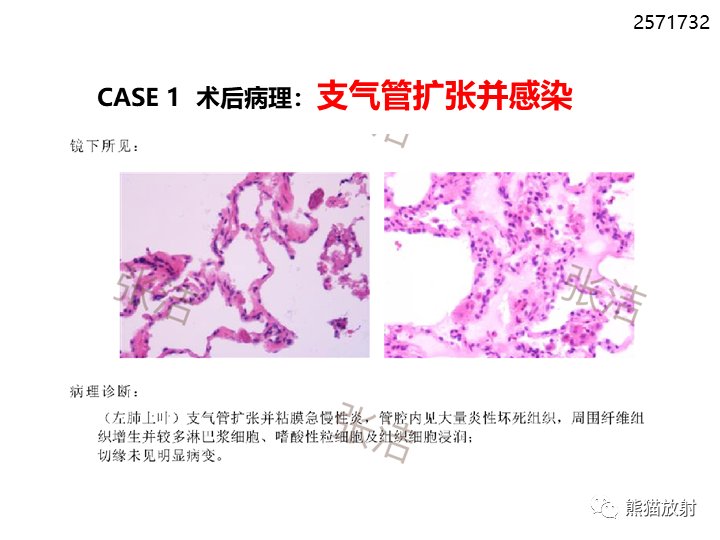 影像PPT - 【病例】支气管扩张并感染VS微浸润性腺癌-23