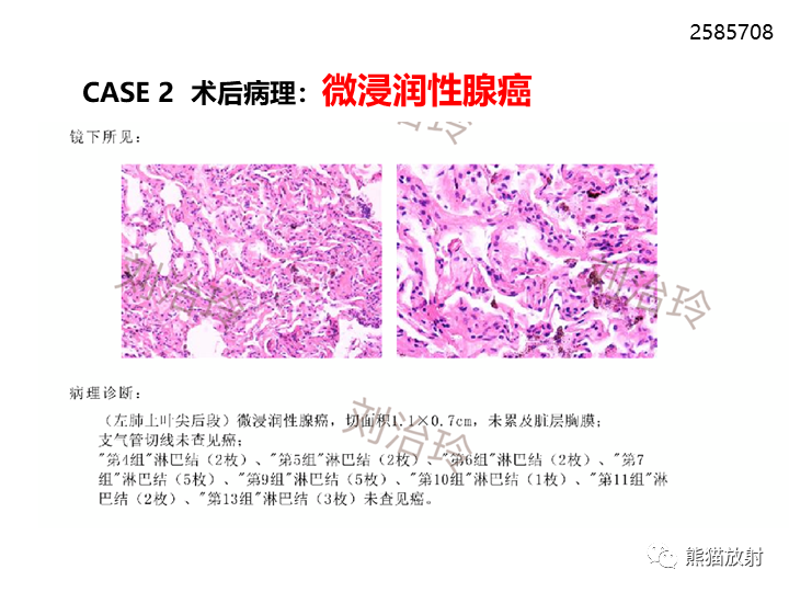 影像PPT - 【病例】支气管扩张并感染VS微浸润性腺癌-25
