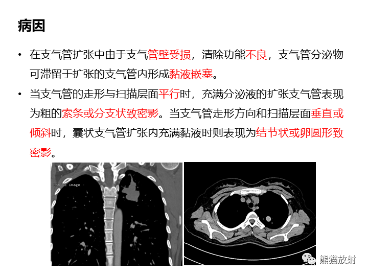 影像PPT - 【病例】支气管扩张并感染VS微浸润性腺癌-27