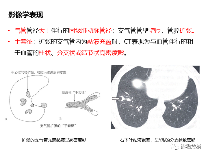 影像PPT - 【病例】支气管扩张并感染VS微浸润性腺癌-28