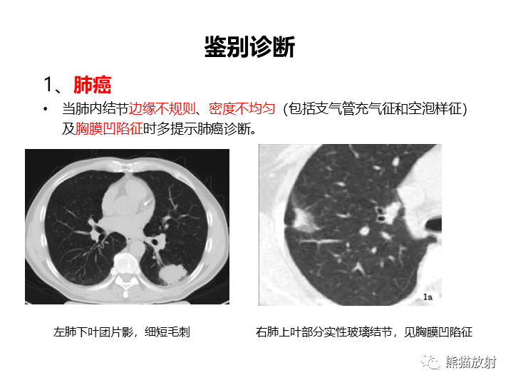 影像PPT - 【病例】支气管扩张并感染VS微浸润性腺癌-30