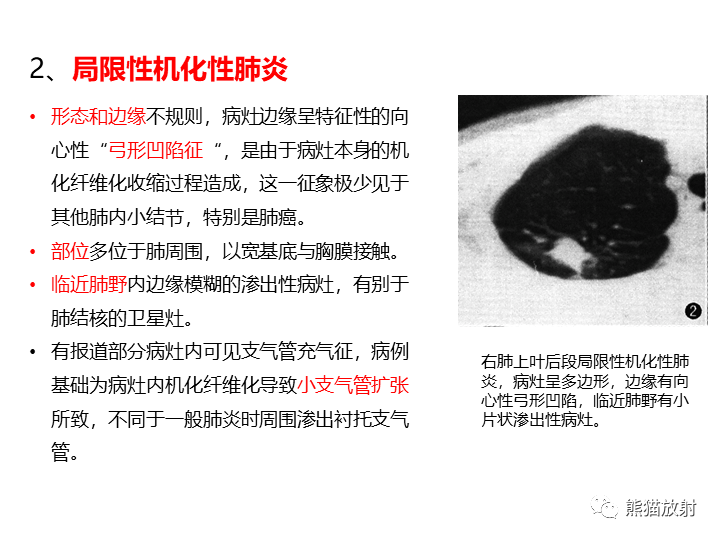 影像PPT - 【病例】支气管扩张并感染VS微浸润性腺癌-31