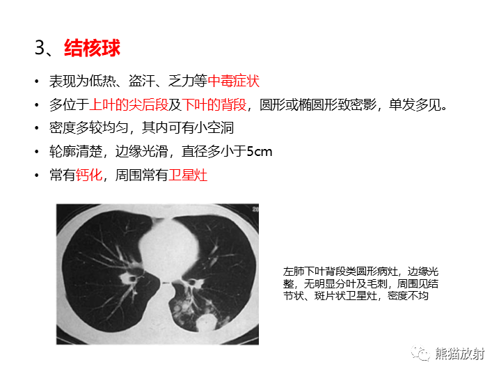 影像PPT - 【病例】支气管扩张并感染VS微浸润性腺癌-32