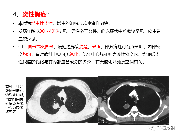 影像PPT - 【病例】支气管扩张并感染VS微浸润性腺癌-33