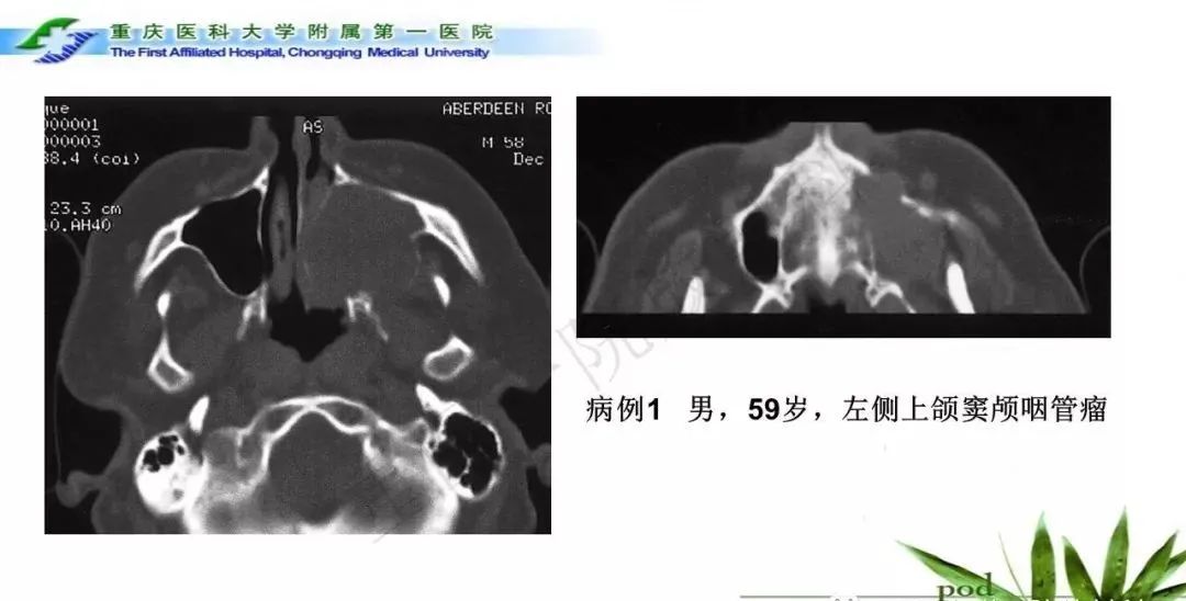 影像PPT - 【PPT】鞍下颅咽管瘤的诊断与鉴别诊断-14