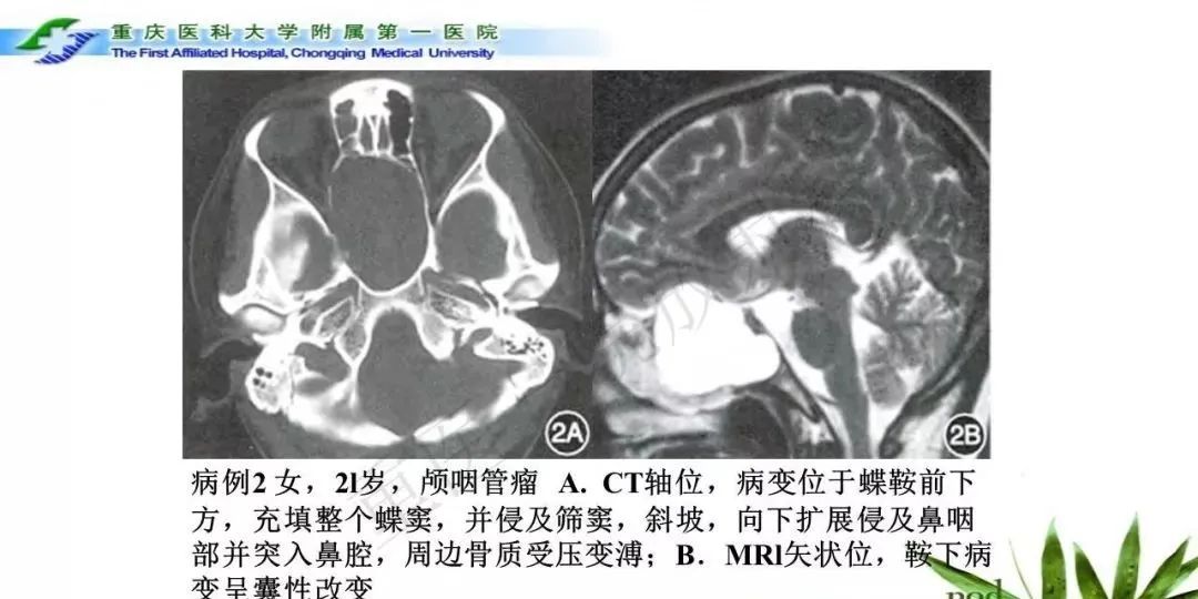 影像PPT - 【PPT】鞍下颅咽管瘤的诊断与鉴别诊断-15