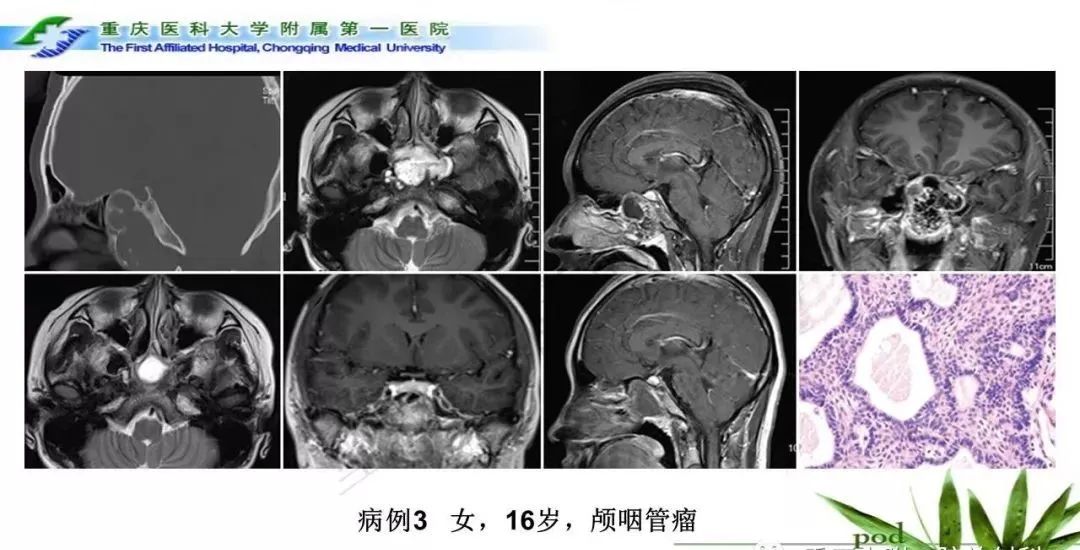 影像PPT - 【PPT】鞍下颅咽管瘤的诊断与鉴别诊断-16