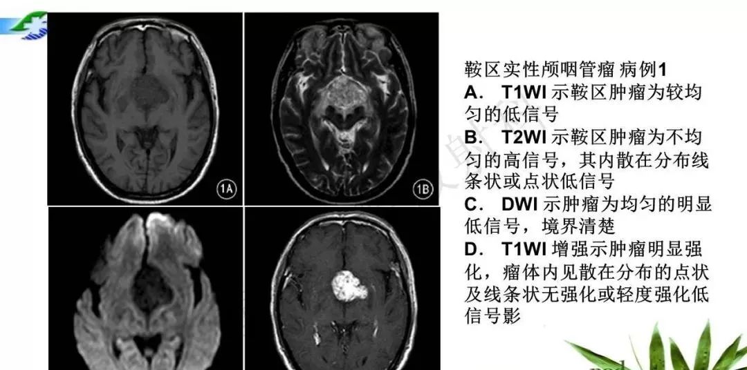 影像PPT - 【PPT】鞍下颅咽管瘤的诊断与鉴别诊断-17