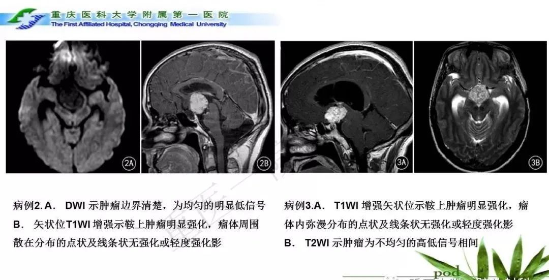 影像PPT - 【PPT】鞍下颅咽管瘤的诊断与鉴别诊断-18