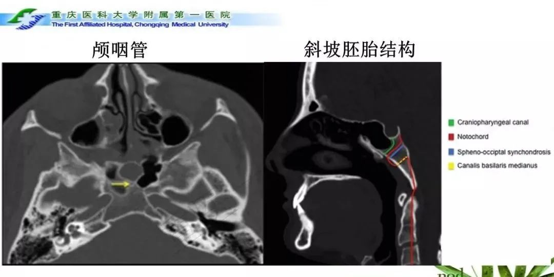 影像PPT - 【PPT】鞍下颅咽管瘤的诊断与鉴别诊断-19