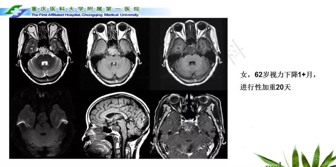影像PPT - 【PPT】鞍下颅咽管瘤的诊断与鉴别诊断-23