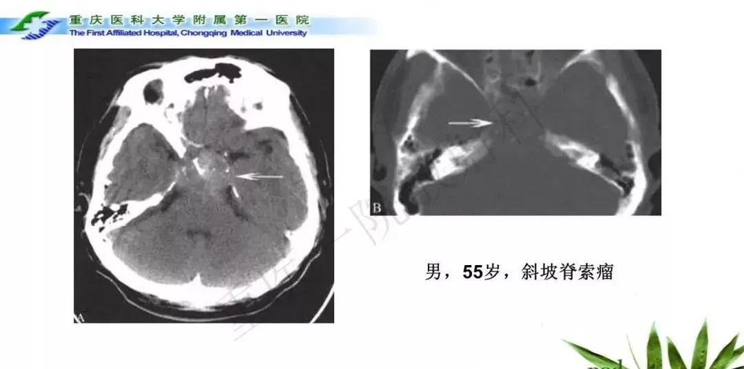 影像PPT - 【PPT】鞍下颅咽管瘤的诊断与鉴别诊断-24