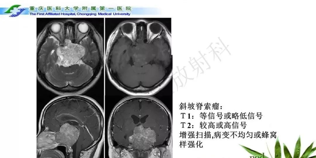 影像PPT - 【PPT】鞍下颅咽管瘤的诊断与鉴别诊断-25
