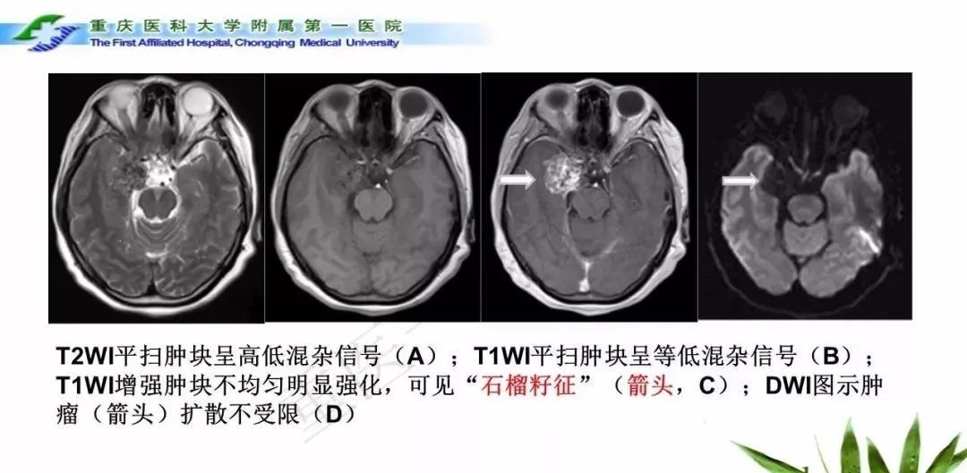 影像PPT - 【PPT】鞍下颅咽管瘤的诊断与鉴别诊断-28