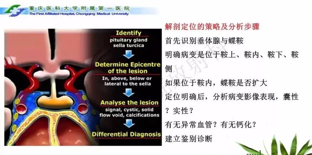 影像PPT - 【PPT】鞍下颅咽管瘤的诊断与鉴别诊断-31