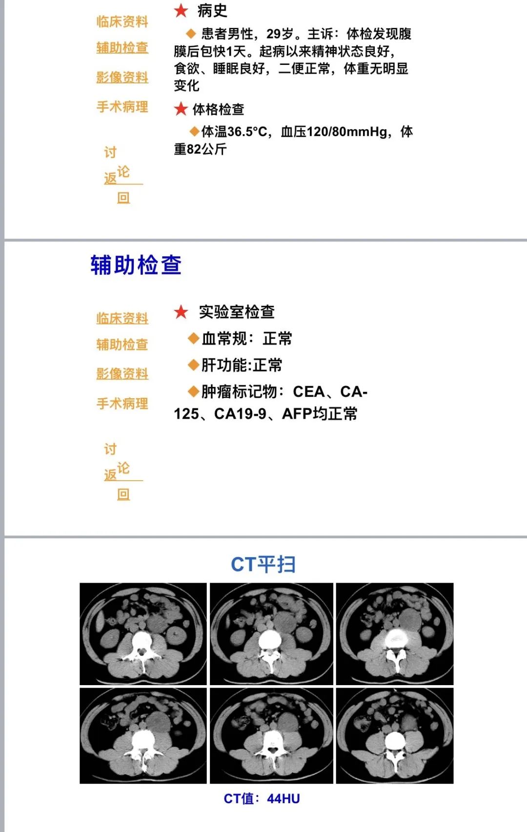 影像PPT - 【病例】腹膜后上皮样血管内皮瘤1例CT-1