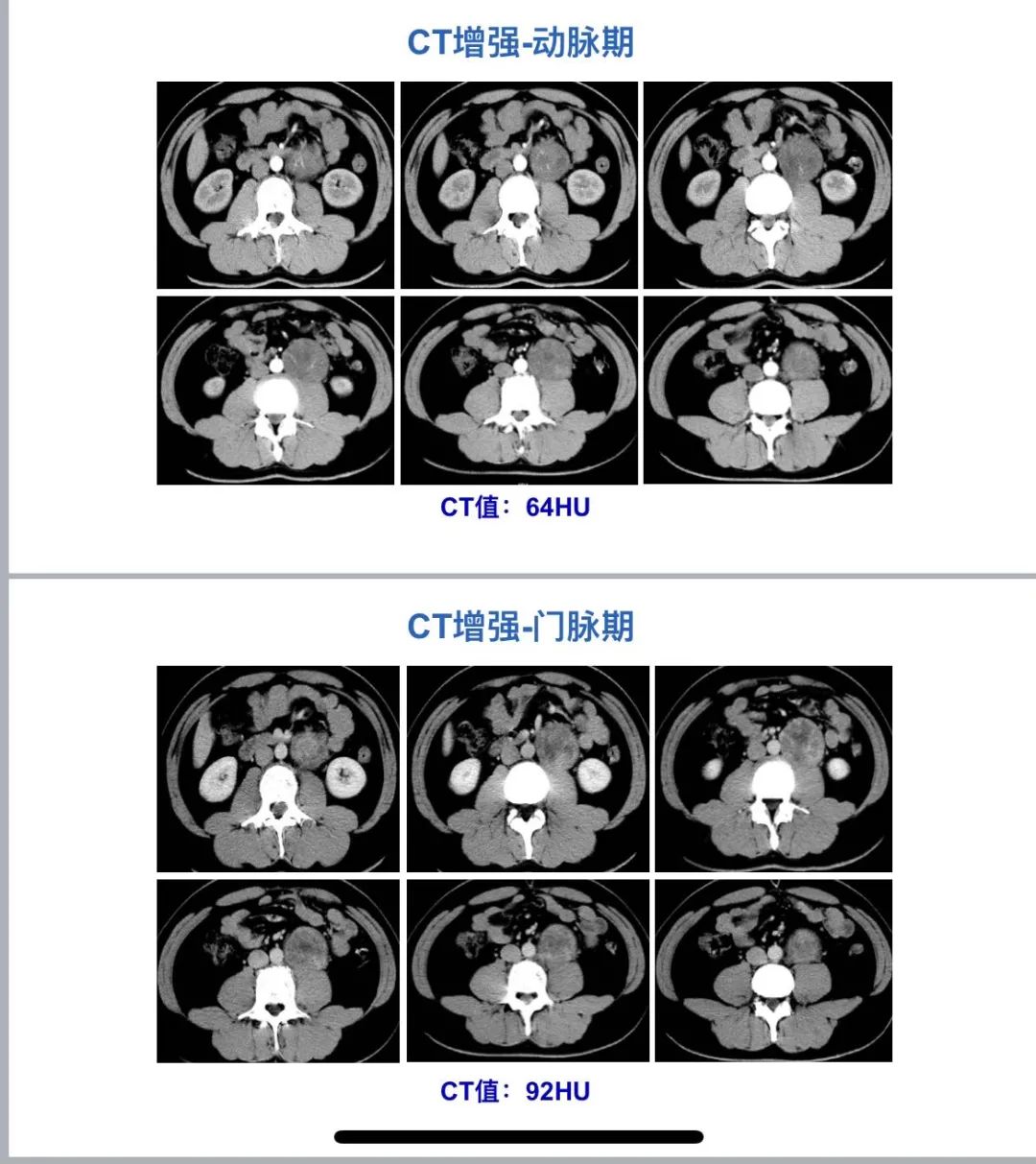 影像PPT - 【病例】腹膜后上皮样血管内皮瘤1例CT-2