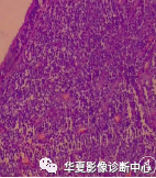 影像PPT - 【病例】鼻腔鼻窦胚胎性横纹肌肉瘤1例CT及MR-2 影像PPT - 【病例】鼻腔鼻窦胚胎性横纹肌肉瘤1例CT及MR-2