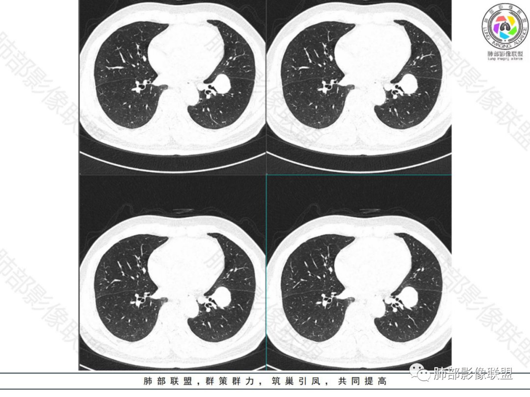 影像PPT - 【病例】左下肺典型类癌1例CT影像讨论-9 影像PPT - 【病例】左下肺典型类癌1例CT影像讨论-9