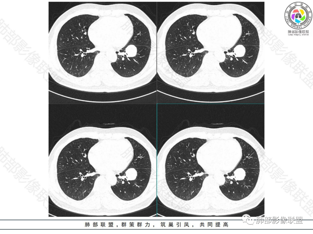 影像PPT - 【病例】左下肺典型类癌1例CT影像讨论-10 影像PPT - 【病例】左下肺典型类癌1例CT影像讨论-10