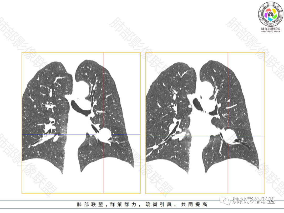 影像PPT - 【病例】左下肺典型类癌1例CT影像讨论-13 影像PPT - 【病例】左下肺典型类癌1例CT影像讨论-13