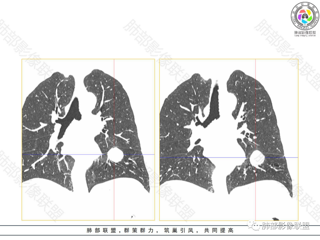 影像PPT - 【病例】左下肺典型类癌1例CT影像讨论-15 影像PPT - 【病例】左下肺典型类癌1例CT影像讨论-15