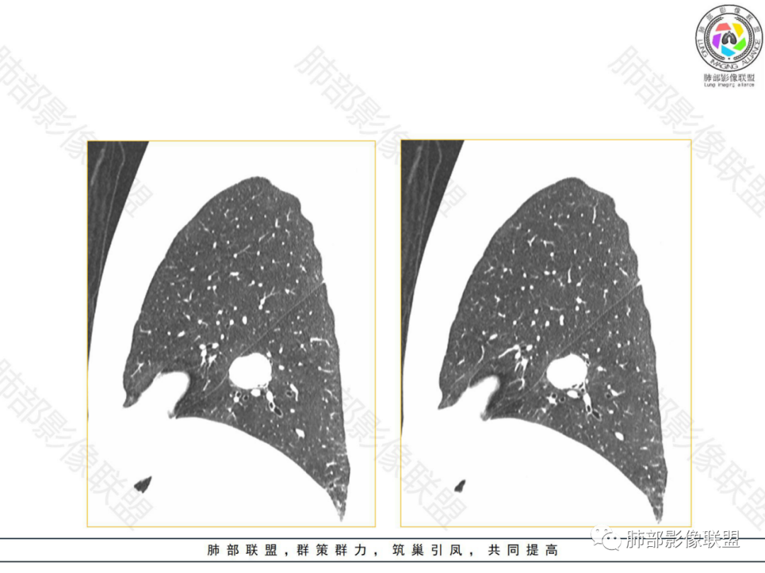 影像PPT - 【病例】左下肺典型类癌1例CT影像讨论-16 影像PPT - 【病例】左下肺典型类癌1例CT影像讨论-16