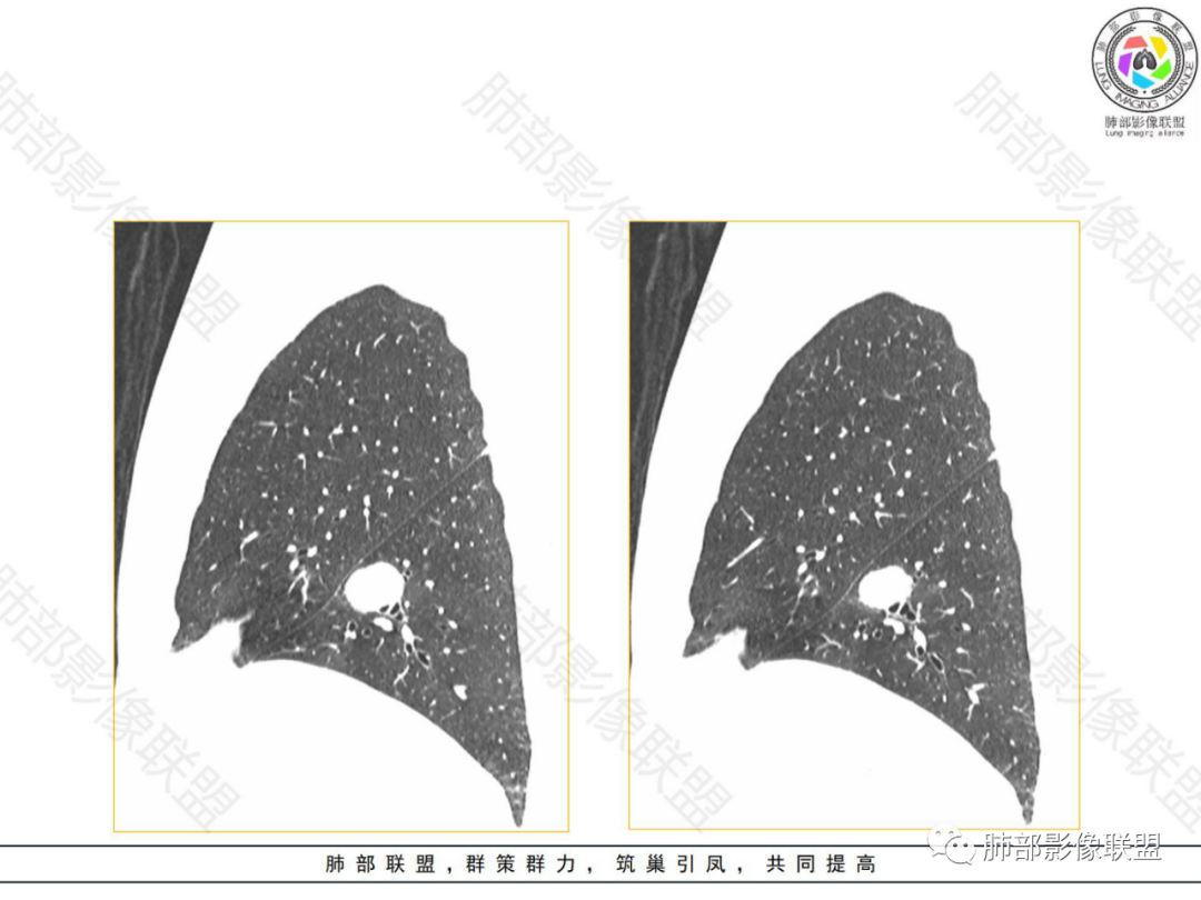 影像PPT - 【病例】左下肺典型类癌1例CT影像讨论-17 影像PPT - 【病例】左下肺典型类癌1例CT影像讨论-17