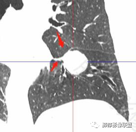 影像PPT - 【病例】左下肺典型类癌1例CT影像讨论-22 影像PPT - 【病例】左下肺典型类癌1例CT影像讨论-22