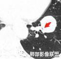 影像PPT - 【病例】左下肺典型类癌1例CT影像讨论-23 影像PPT - 【病例】左下肺典型类癌1例CT影像讨论-23