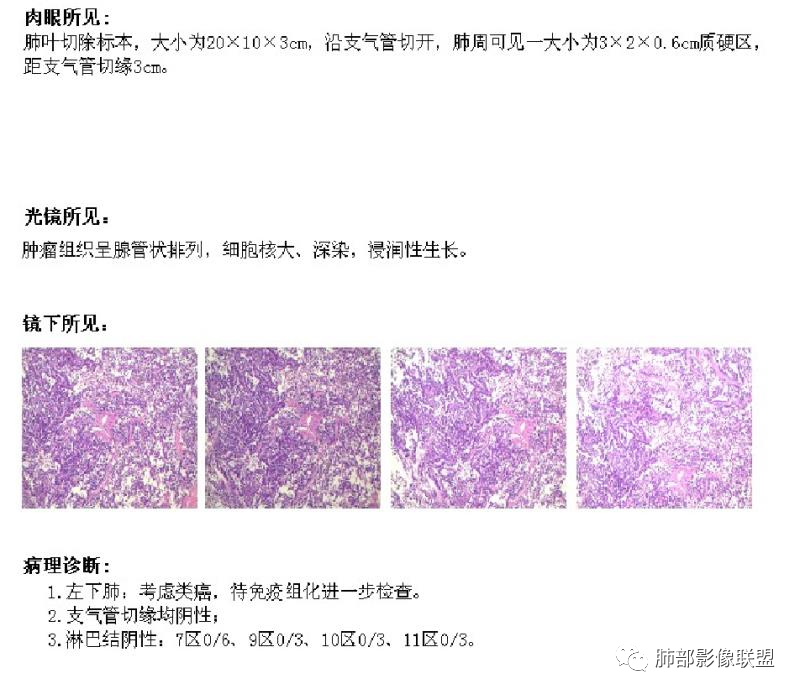 影像PPT - 【病例】左下肺典型类癌1例CT影像讨论-32 影像PPT - 【病例】左下肺典型类癌1例CT影像讨论-32