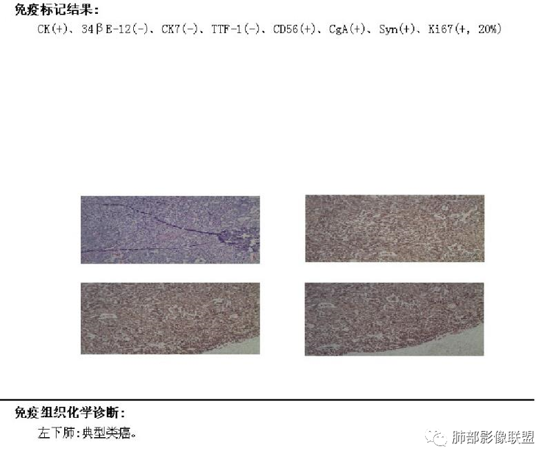 影像PPT - 【病例】左下肺典型类癌1例CT影像讨论-33 影像PPT - 【病例】左下肺典型类癌1例CT影像讨论-33