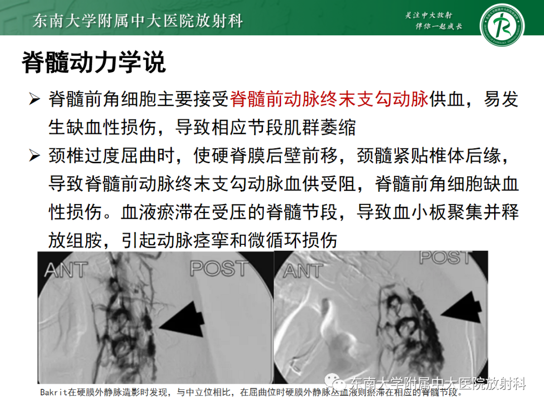 影像PPT - 【病例】平山病1例MR影像-8 影像PPT - 【病例】平山病1例MR影像-8