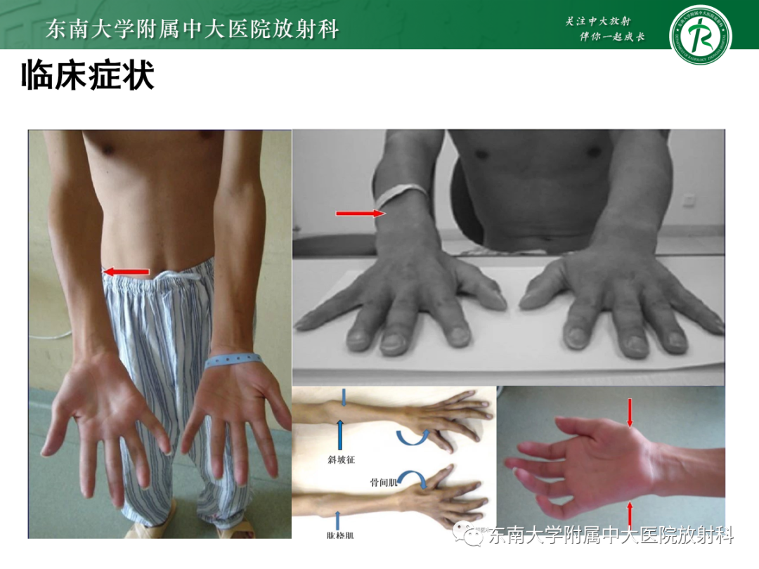 影像PPT - 【病例】平山病1例MR影像-12 影像PPT - 【病例】平山病1例MR影像-12
