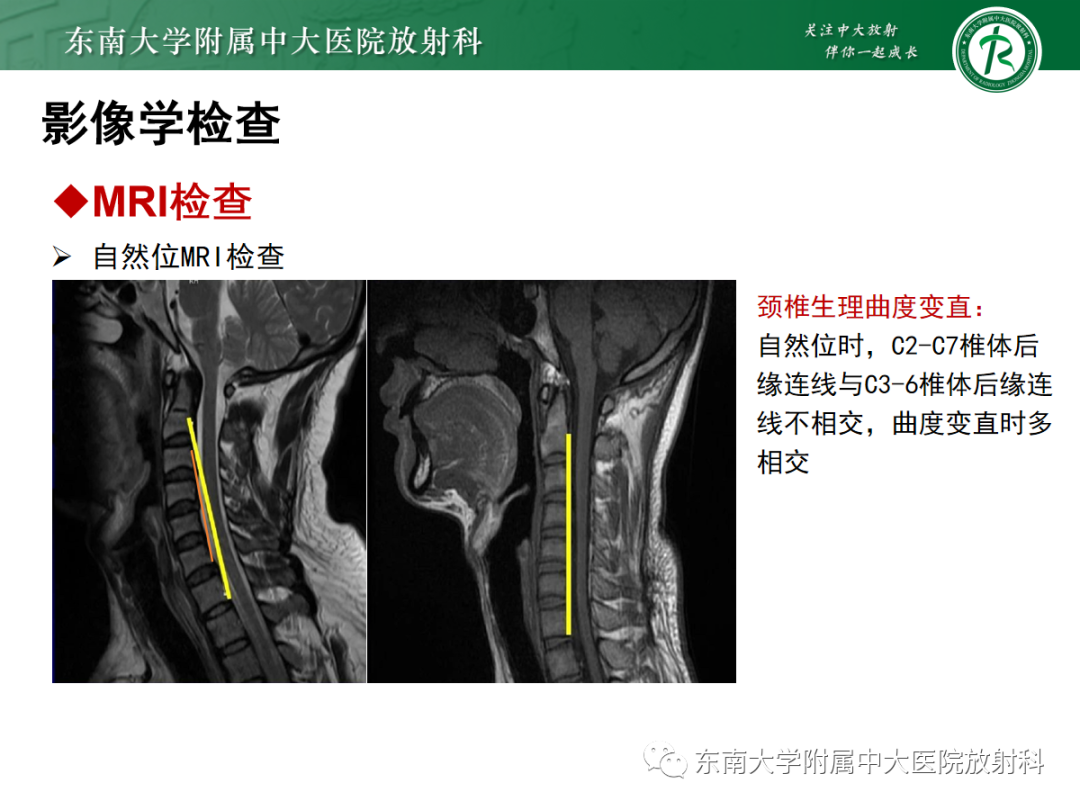 影像PPT - 【病例】平山病1例MR影像-17 影像PPT - 【病例】平山病1例MR影像-17