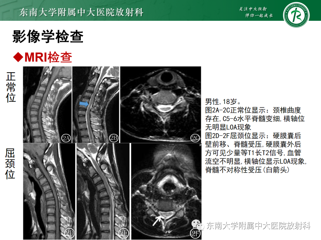 影像PPT - 【病例】平山病1例MR影像-18 影像PPT - 【病例】平山病1例MR影像-18
