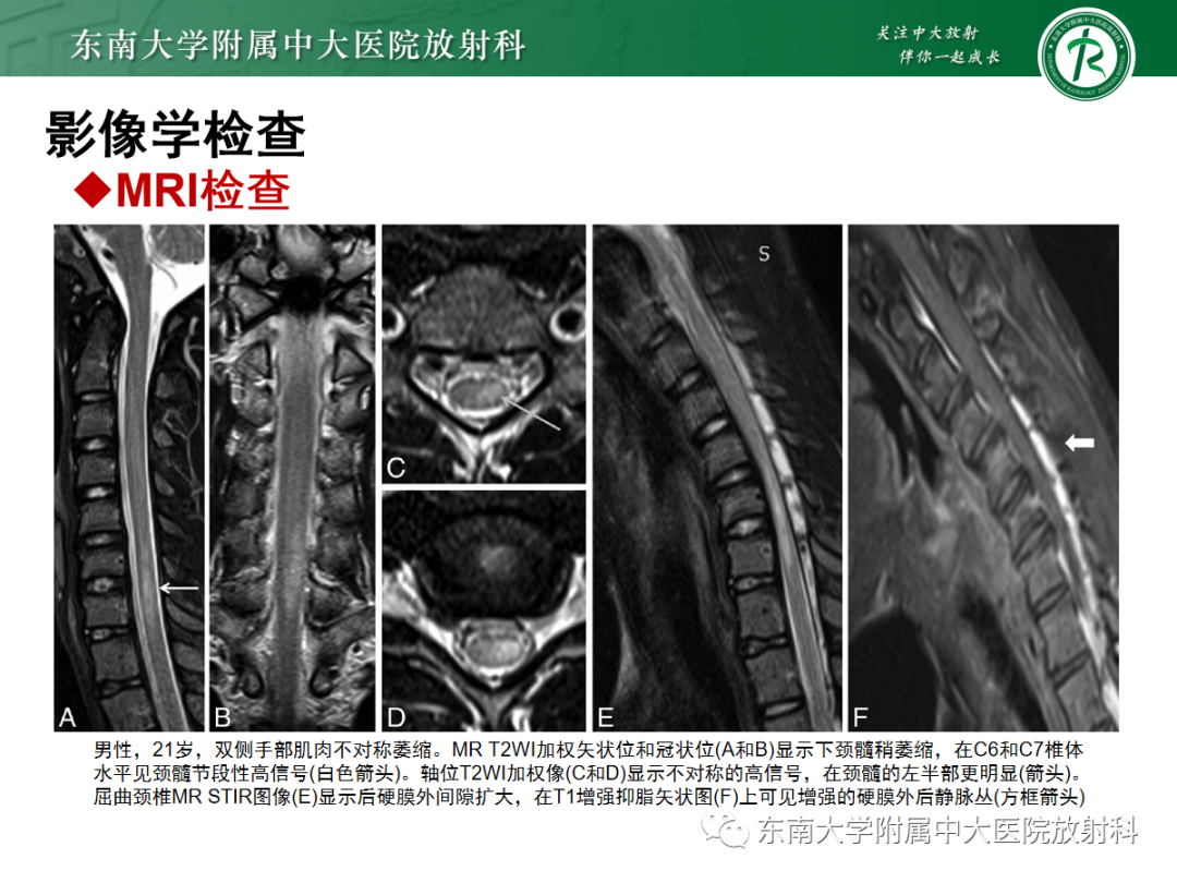 影像PPT - 【病例】平山病1例MR影像-20 影像PPT - 【病例】平山病1例MR影像-20