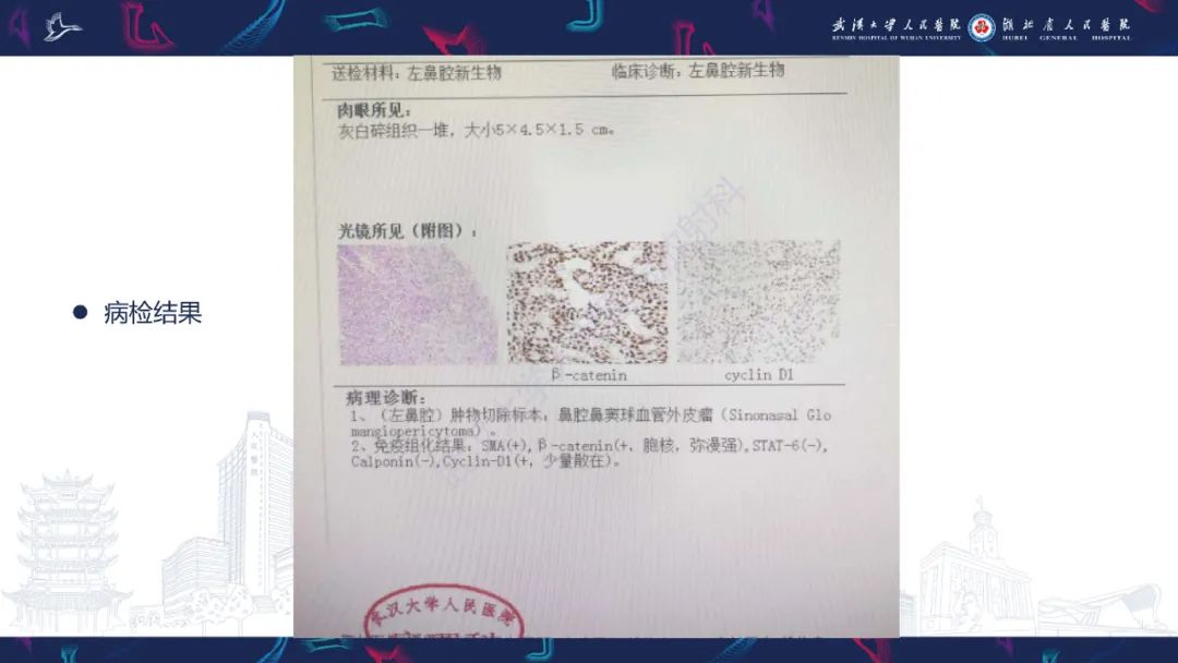 影像PPT - 【PPT】鼻腔鼻窦球血管外皮瘤影像诊断-6
