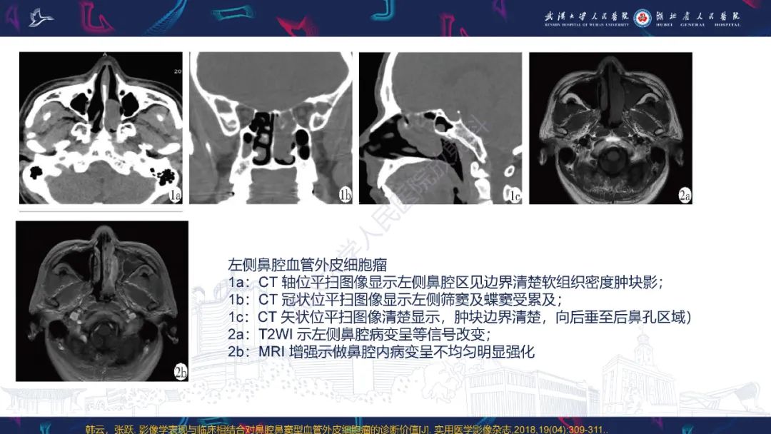 影像PPT - 【PPT】鼻腔鼻窦球血管外皮瘤影像诊断-17