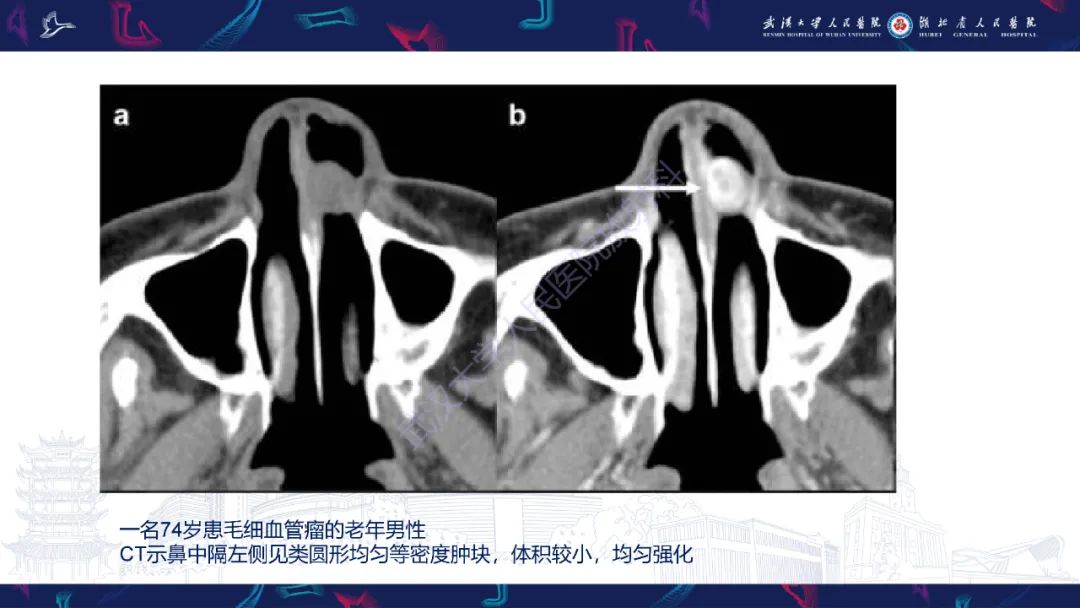 影像PPT - 【PPT】鼻腔鼻窦球血管外皮瘤影像诊断-22