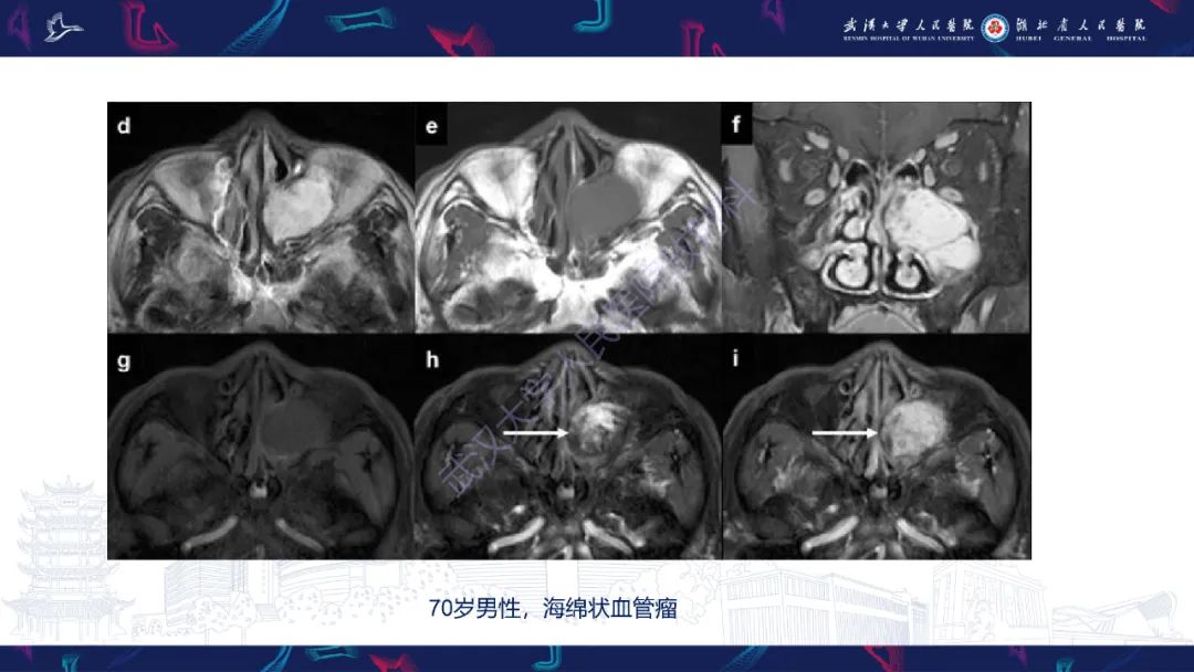 影像PPT - 【PPT】鼻腔鼻窦球血管外皮瘤影像诊断-23