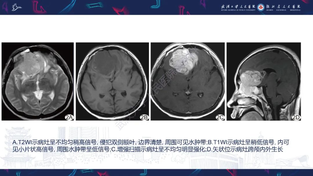 影像PPT - 【PPT】鼻腔鼻窦球血管外皮瘤影像诊断-25