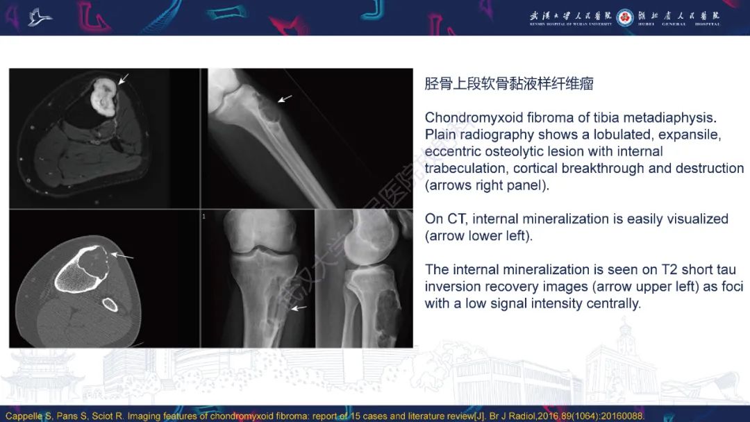 影像PPT - 【PPT】鼻腔鼻窦球血管外皮瘤影像诊断-26