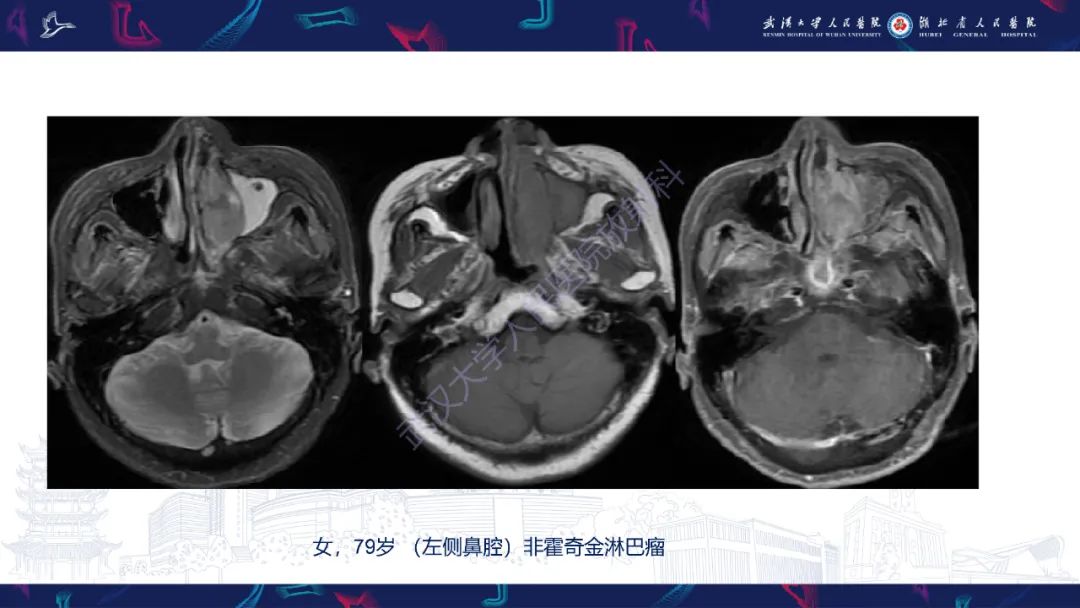 影像PPT - 【PPT】鼻腔鼻窦球血管外皮瘤影像诊断-28
