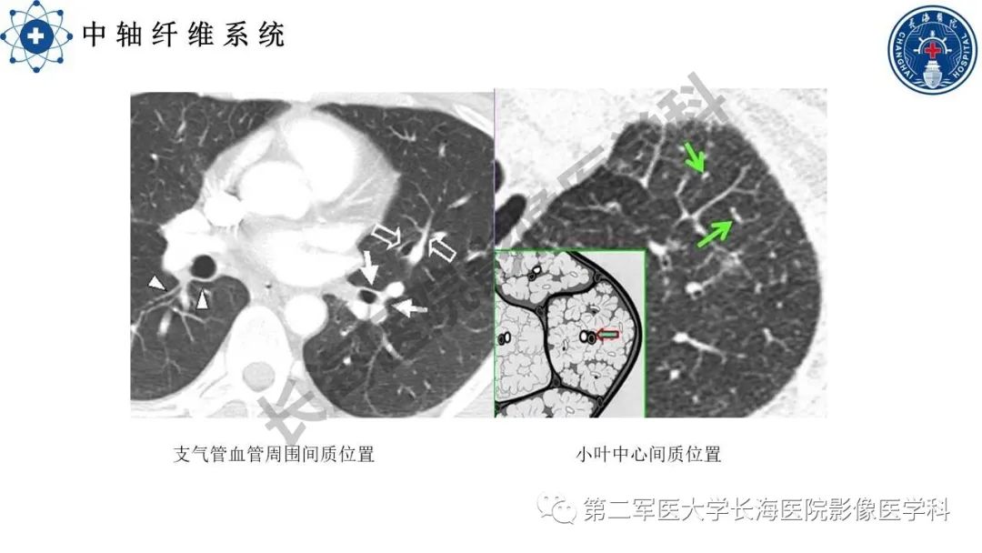 影像PPT - 【PPT】特发性肺纤维化的影像表现-9