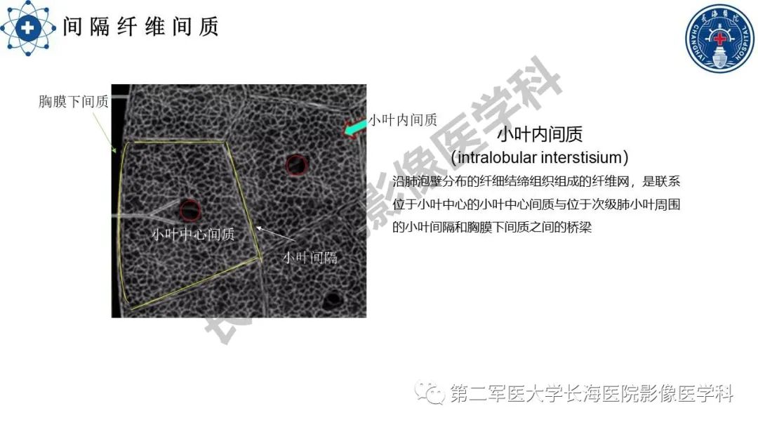 影像PPT - 【PPT】特发性肺纤维化的影像表现-11