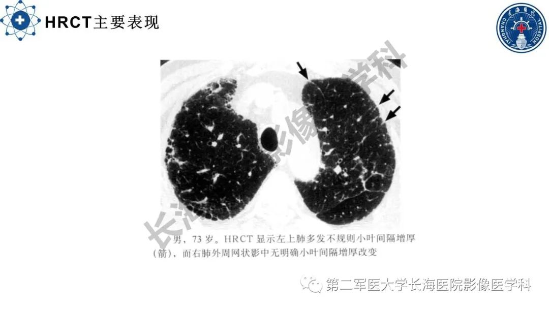 影像PPT - 【PPT】特发性肺纤维化的影像表现-14
