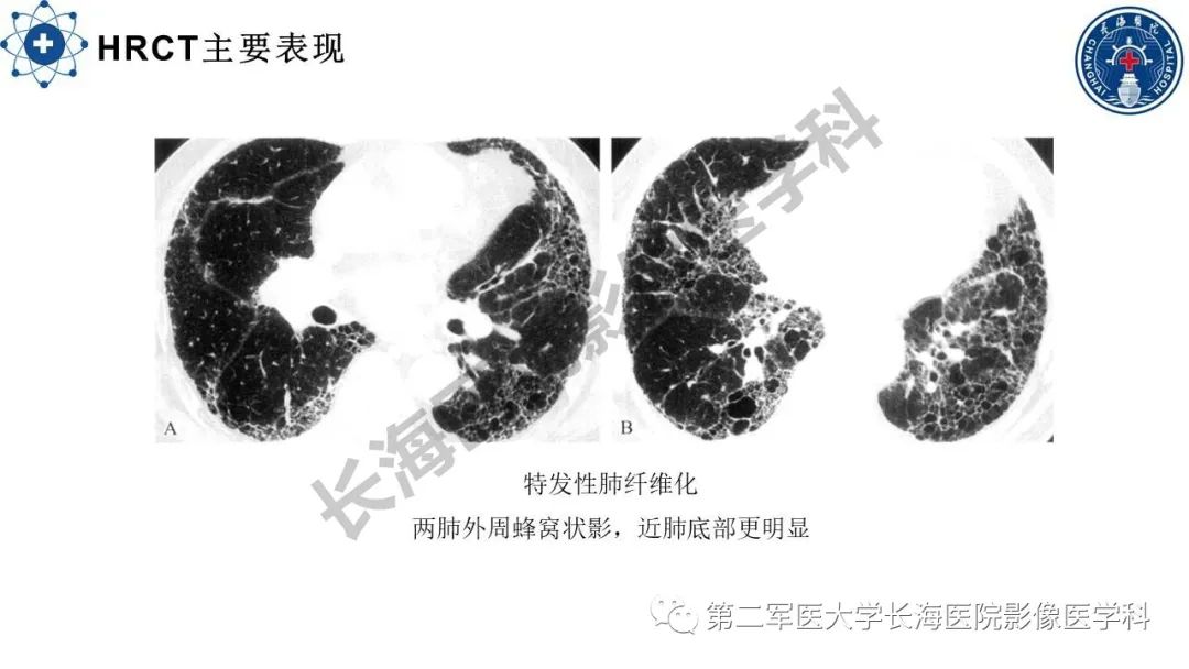 影像PPT - 【PPT】特发性肺纤维化的影像表现-15