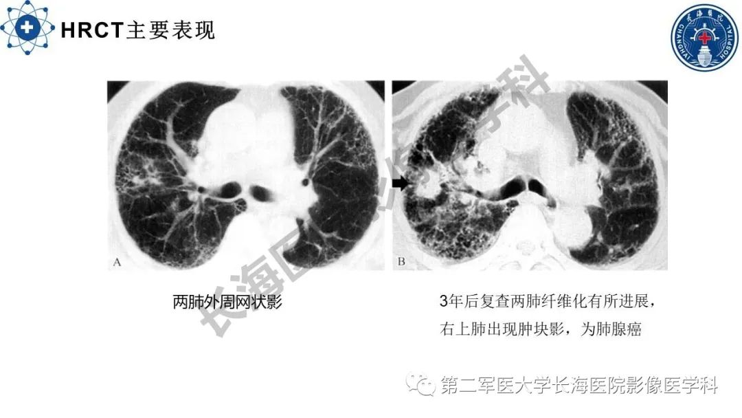 影像PPT - 【PPT】特发性肺纤维化的影像表现-16