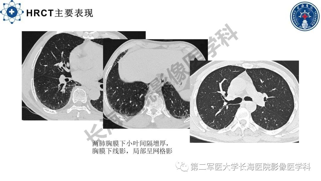 影像PPT - 【PPT】特发性肺纤维化的影像表现-17